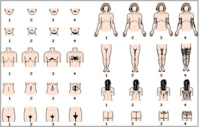 Diagnóstico da Síndrome do Ovário Policístico 1 hirsutismo
