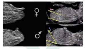 Como Identificar o Sexo do Bebe no Ultrassom 1 sexodobebe