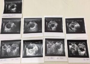 Acupuntura no Tratamento da Infertilidade 2 endometrioma2