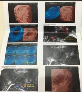 Acupuntura no Tratamento da Infertilidade 1 endometriomaa